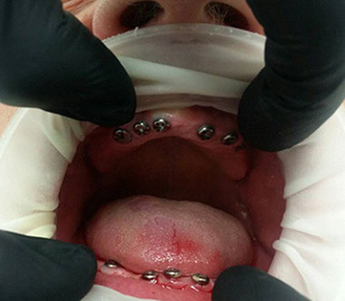 zubná chirurgia, implantológia, protetika, ošetrenie zubov, Chirurgické extrakcie, anestéza