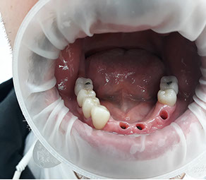 Implantácia sólo koruniek, Implantat, zubny implantat, korunka na implantat, zubna chirurgia, implantologia, extrakcie zubov mudrosti, resekcie,