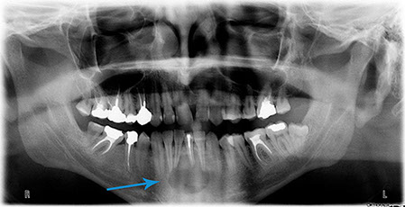 cystektómie,Chýbajúci zub. http://drkasaj.sk/ , http://drkasaj.sk/zubnaimplantologia.html , Martin, martin, drkasaj.sk, Marián Kasaj, Zubná 