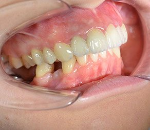Implantácia sólo koruniek. Implantat, zubny implantat, korunka na implantat, zubna chirurgia, implantologia, extrakcie zubov mudrosti, resekcie,