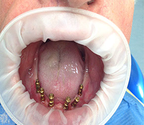 Implantat, zubny implantat, korunka na implantat, zubna chirurgia, implantologia, extrakcie zubov mudrosti, resekcie, zubna ambulancia, zuby