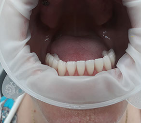 Implantácia sólo koruniek, Implantat, zubny implantat, korunka na implantat, zubna chirurgia, implantologia, extrakcie zubov mudrosti, resekcie,