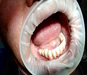 Fixné mostíky na implantátoch, Chýbajúci zub. http://drkasaj.sk/ , http://drkasaj.sk/zubnaimplantologia.html , Martin, martin, drkasaj.sk, 