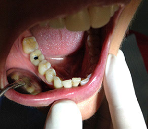 implantácia sólo koruniek, Implantat, zubny implantat, korunka na implantat, zubna chirurgia, implantologia, extrakcie zubov mudrosti, resekcie,