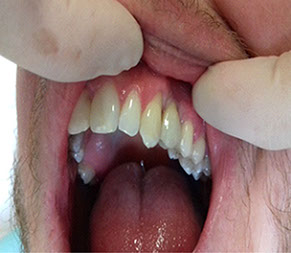 Fixné mostíky na implantátoch, Chýbajúci zub. http://drkasaj.sk/ , http://drkasaj.sk/zubnaimplantologia.html , Martin, martin, drkasaj.sk,