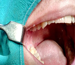 chirurgické extrakcie zubov