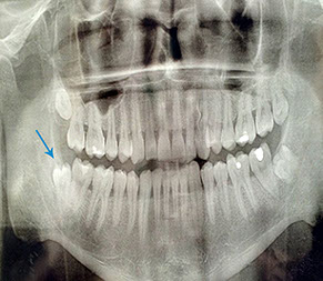 chirurgické extrakcie zubov,Chýbajúci zub. http://drkasaj.sk/ , http://drkasaj.sk/zubnaimplantologia.html , Martin, martin, drkasaj.sk, kasaj