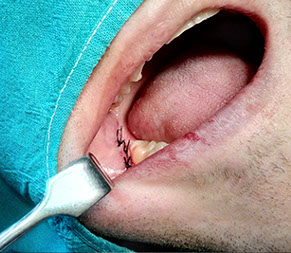 chirurgické extrakcie zubov,Chýbajúci zub. http://drkasaj.sk/ , http://drkasaj.sk/zubnaimplantologia.html , Martin, martin, drkasaj.sk, Kasaj